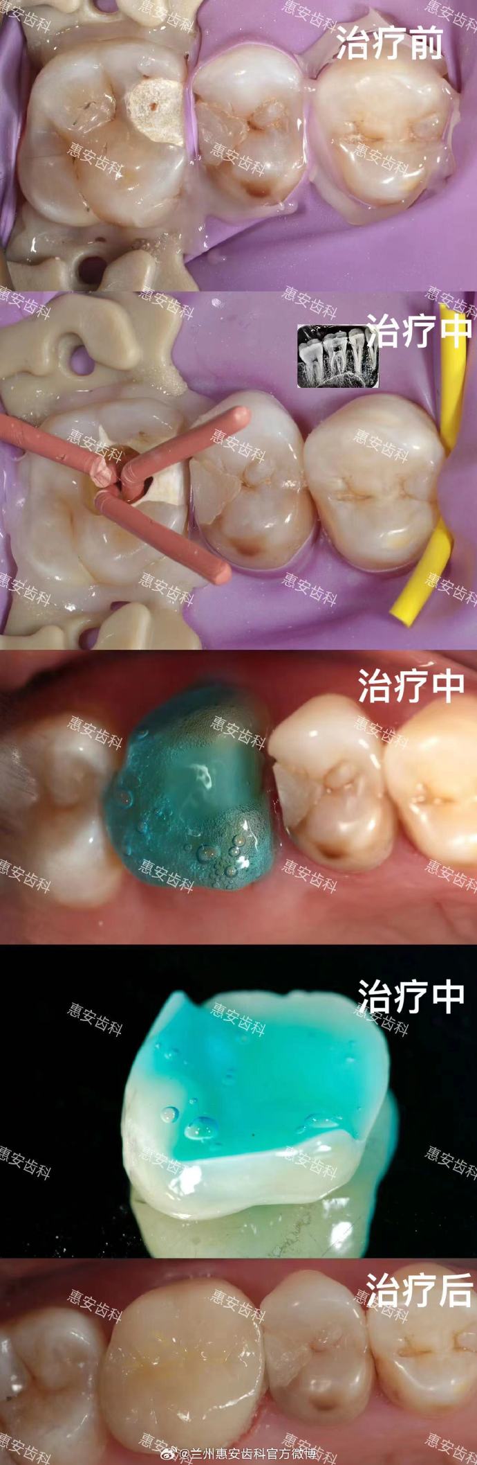 兰州牙科,兰州根管治疗,根管治疗多少钱