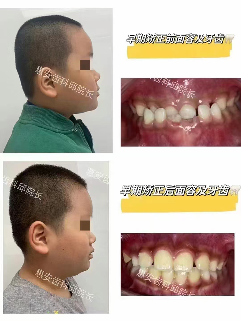 兰州牙齿矫正,兰州牙齿矫正医院,兰州牙齿矫正口腔,兰州牙齿矫正费用,兰州牙齿矫正价格
