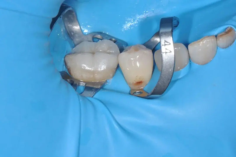 兰州牙科,兰州种植牙,兰州口腔,兰州种植牙医院,兰州种植牙口腔