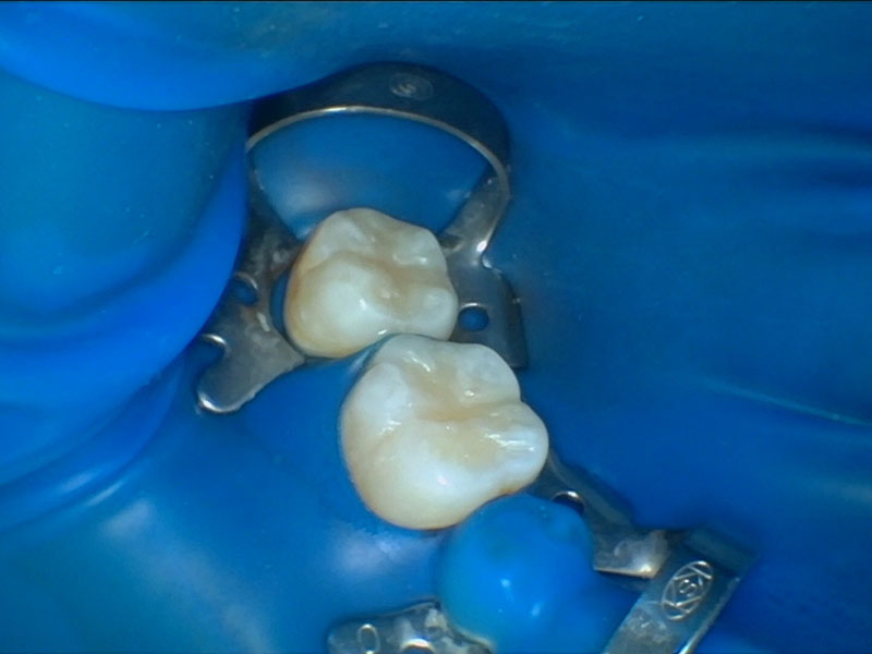 兰州牙科，兰州口腔，兰州根管，兰州根管推荐，兰州根管治疗，兰州根管哪家好